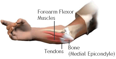 Flexor Tendonitis